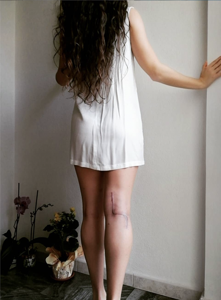 L'apneista Yara Espis e la sua cicatrice in seguito all'intervento all'arteria poplitea